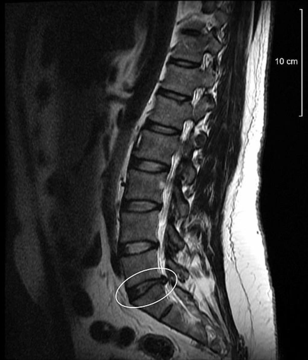 On Site MRI Scan For Back Pain Available Heilman Center